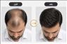 پروتز موی سر طبیعی