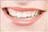زیبایی دندان لومینیرز